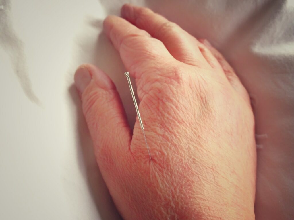 Acupuncture needle in hand