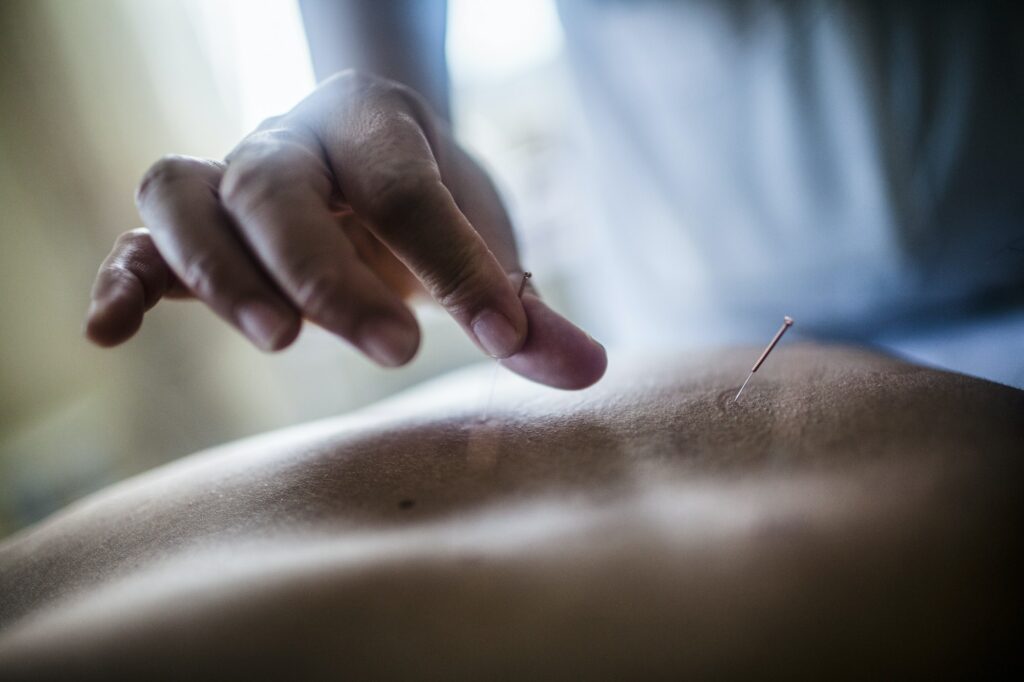 Close up of hand holding fine needle, performing acupuncture on a patient's back