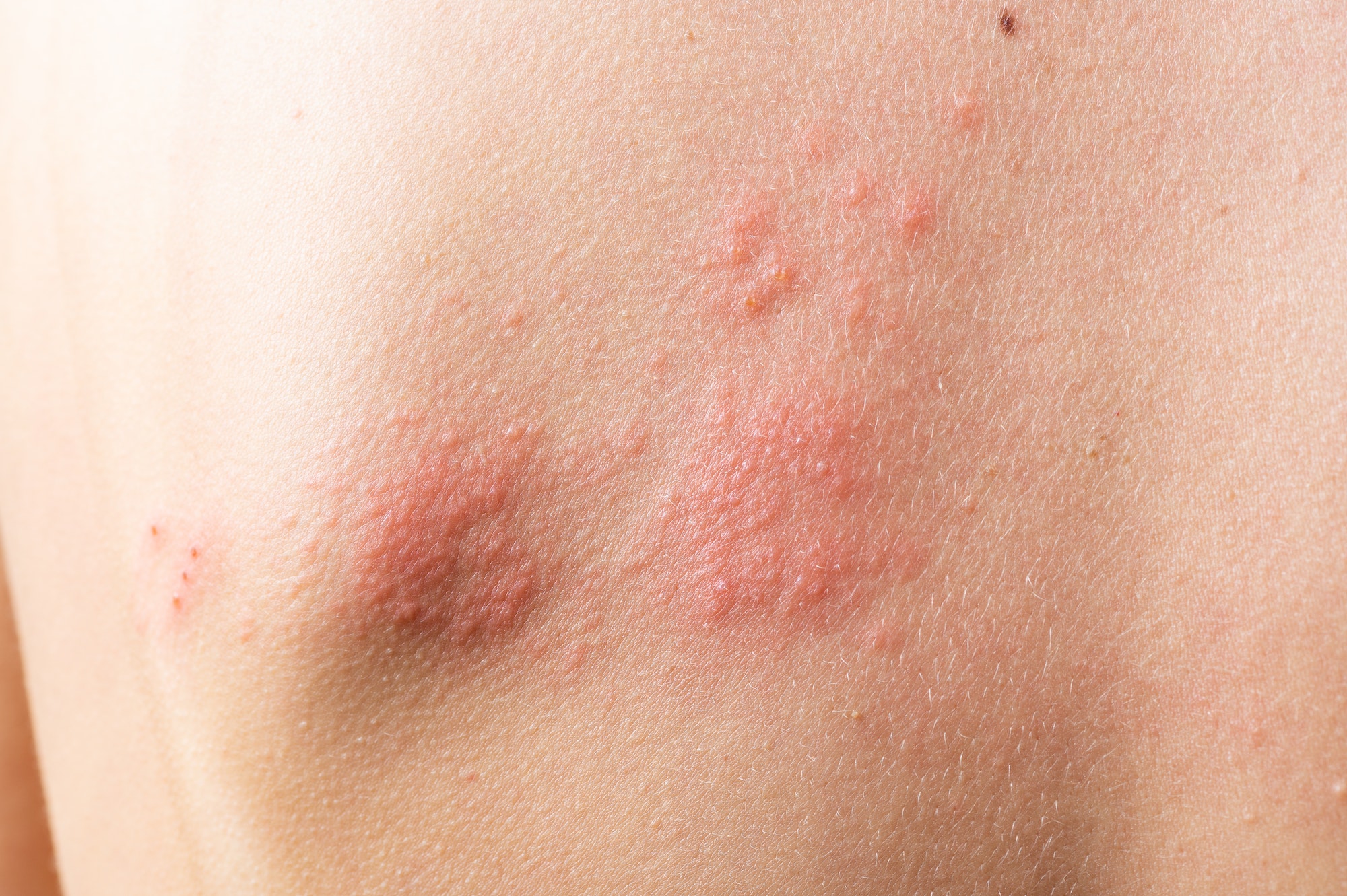 Skin infected Herpes zoster virus. Herpes Virus on body. urticaria rash